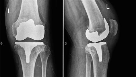 травматична хемартроза на колянната става снимка